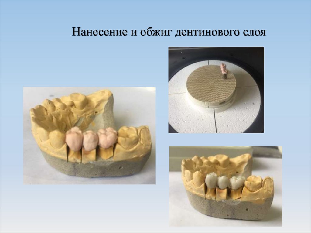 Изготовление мостовидных протезов презентация