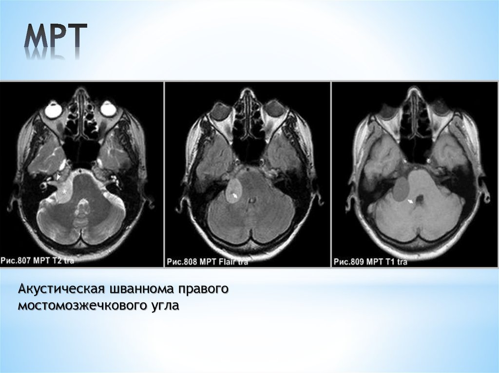 8 пара. Акустическая шваннома мрт. Невринома мосто-мозжечкового угла кт. Опухоль мосто мозжечкового угла мрт. Мостомозжечковый угол анатомия мрт.