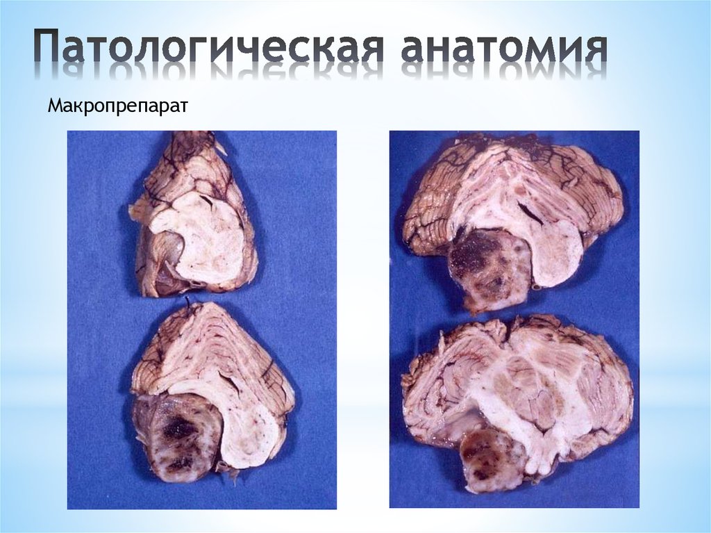 Патологическая анатомия. Макропрепараты патологическая анатомия. Невринома макропрепарат. Клиническая патологическая анатомия.