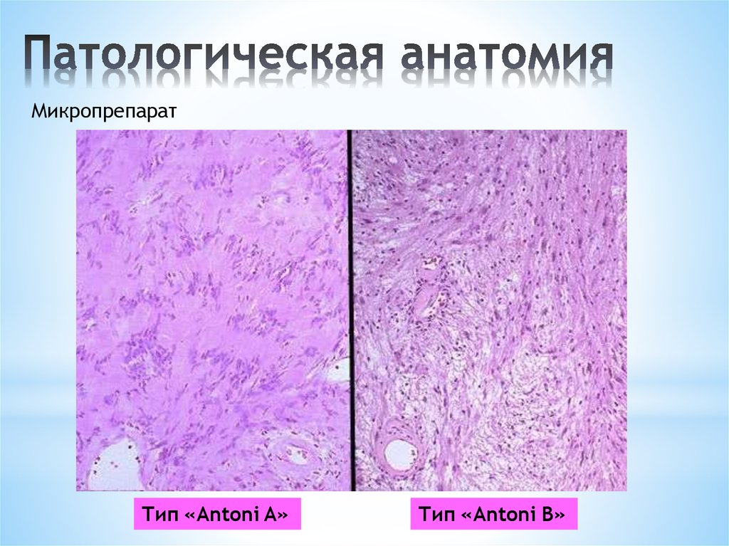 Патологическая анатомия это. Шваннома периферического нерва микропрепарат. Неврилеммома патанатомия. Фибросаркома микропрепарат патологическая анатомия.