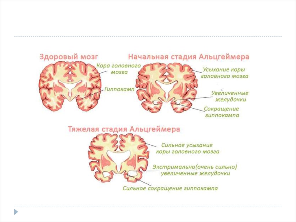 Нейродегенеративное заболевание головного. Нейродегенеративные болезни. Нейродеегенеративные забол. Нейродегенерация головного мозга. Нейродегенеративный процесс головного.