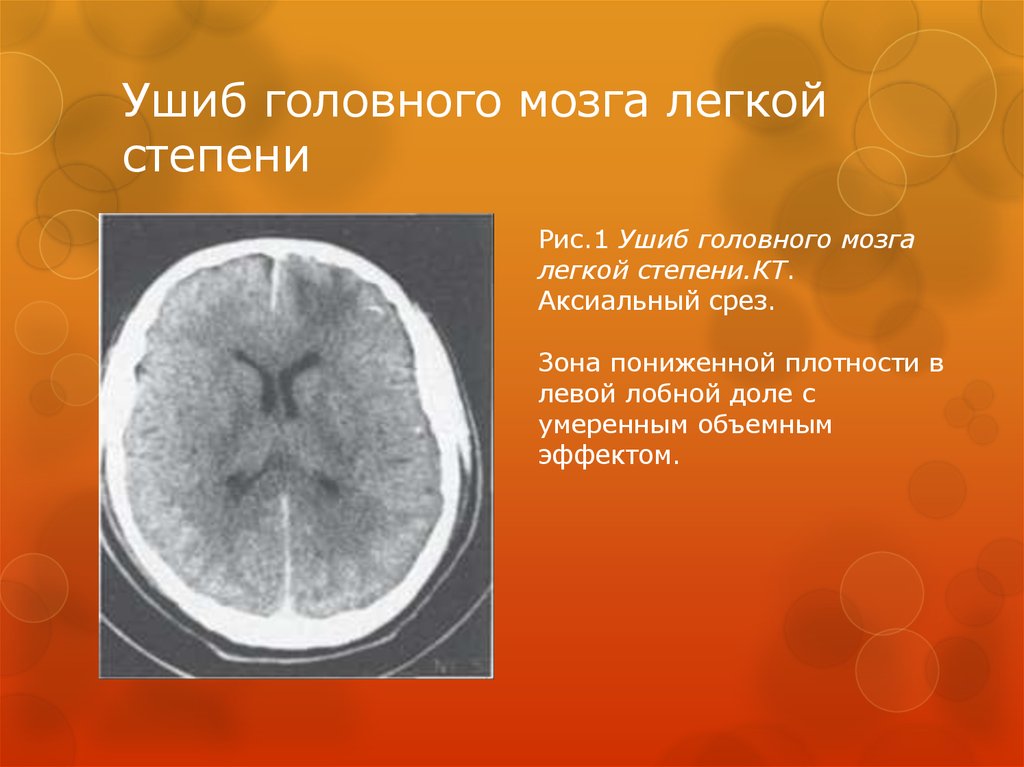 Ушиб головного мозга легкой степени