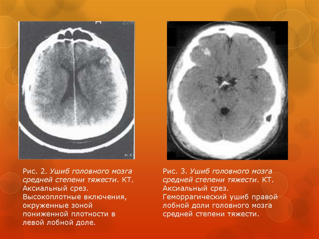 Мозга 2 степени. Контузия головного мозга кт степени. Ушиб головного мозга легкой степени тяжести кт. Ушиб головного мозга средней тяжести кт. Ушиб головного мозга легкой степени кт.