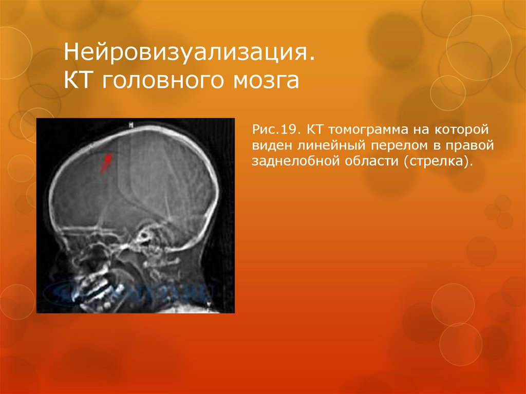 Нейровизуализация. КТ головного мозга