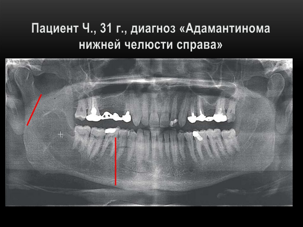 Челюсть справа