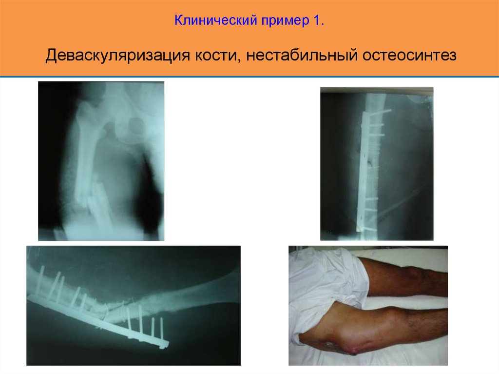 Клинический пример 1. Деваскуляризация кости, нестабильный остеосинтез