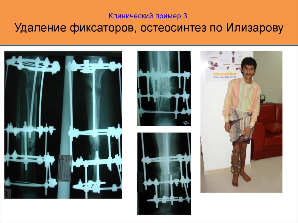 Осложнения остеосинтеза. Перелом голени Илизарова. Монолокальный компрессионный остеосинтез. Фиксационный остеосинтез.