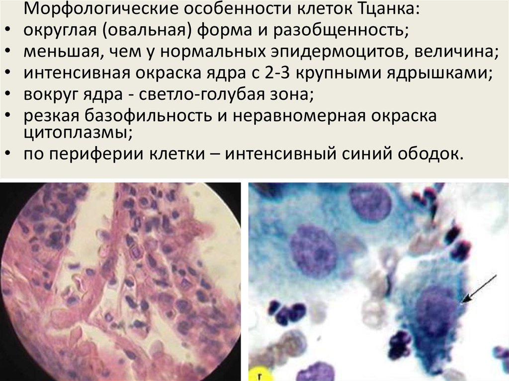 Отсутствие внутриэпителиального поражения. Внутриэпителиальная инвазия бактерий. Внутриэпителиальные макрофаги. Пузырные заболевания кожи. Осложнения пузырных дерматозов.