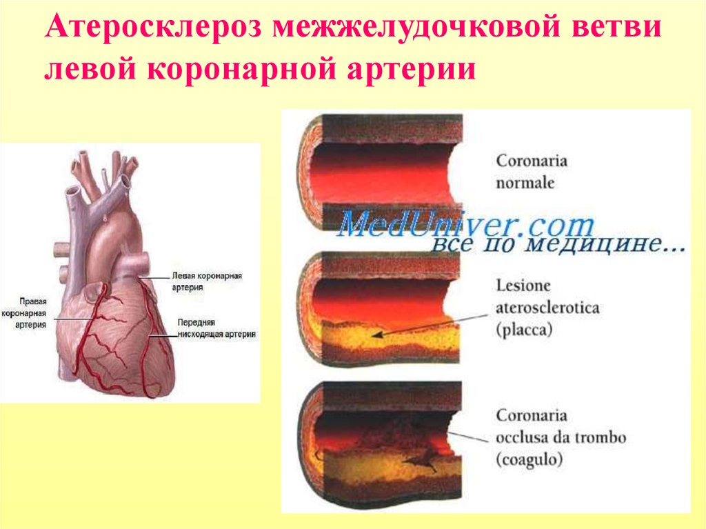 Артерий атеросклероз латынь. Атеросклероз коронарных артерий сосуды. Атеросклероз коронарных артерий причины. Стенозирующий атеросклероз коронарных артерий. Атеросклеротическое поражение коронарных артерий.