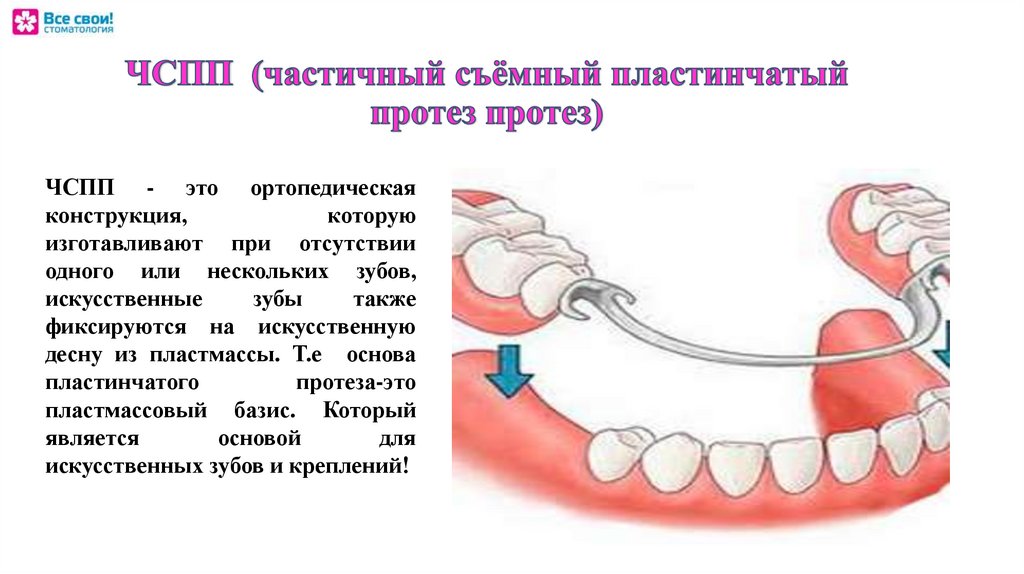 Съемный пластиночный протез показания. Составные элементы частичного съемного протеза. Конструктивные элементы частичного съемного пластиночного протеза. Съемный пластиночный протез составные элементы. Конструкционные элементы съемных пластиночных протезов.