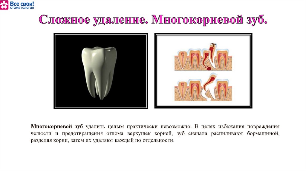 Почему нельзя считать зубы. Анатомия зуб многокорневой. Зуб многокорневые зубы. Сложное удаление зуба (многокорневого).