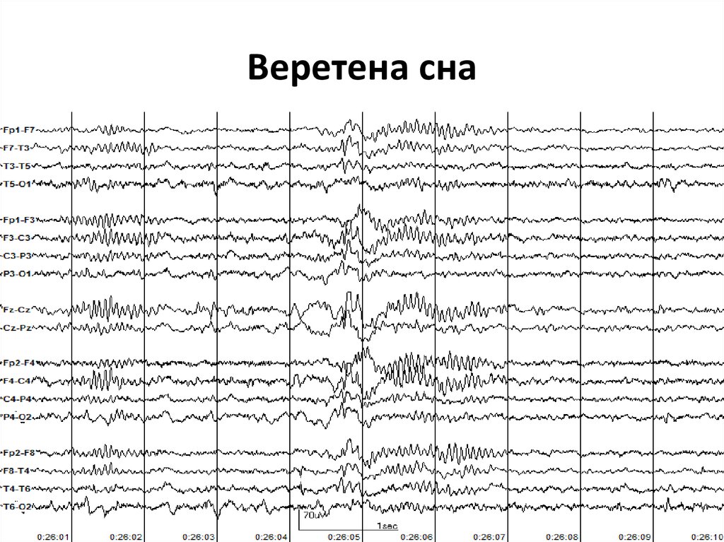 1 нарисовать схему стадий сна по данным ээг