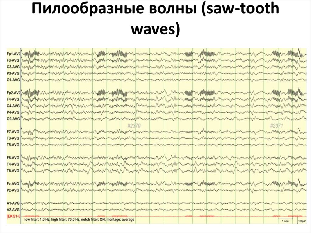 Пилообразные волны (saw-tooth waves)