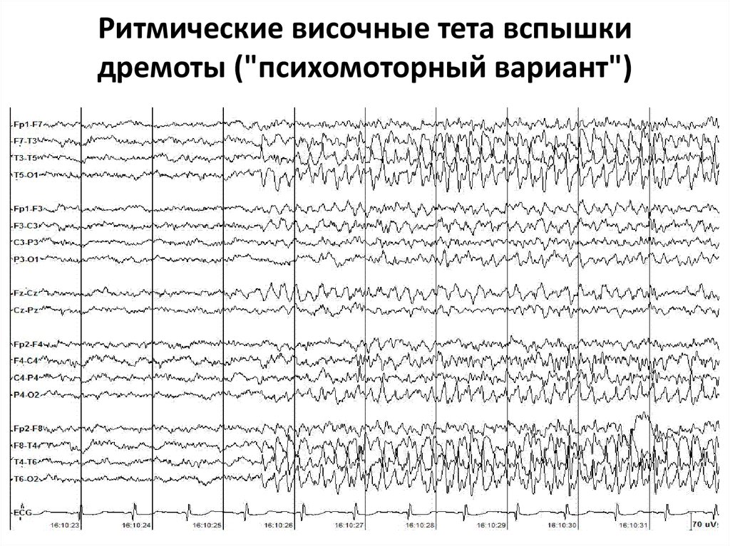 Билатерально синхронная вспышка