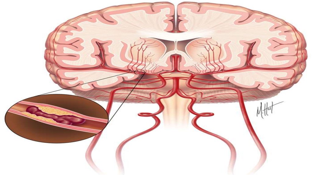 Ischemic stroke. Инсульт. Геморрагический инсульт. Пирацетам при ишемическом инсульте.