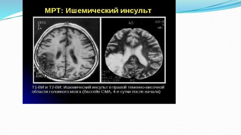 Ишемический инсульт у мужчин. Кт при ишемическом инсульте. Ишемический инсульт кт. Терапевтическое окно ишемического инсульта. Ишемический инсульт мрт.