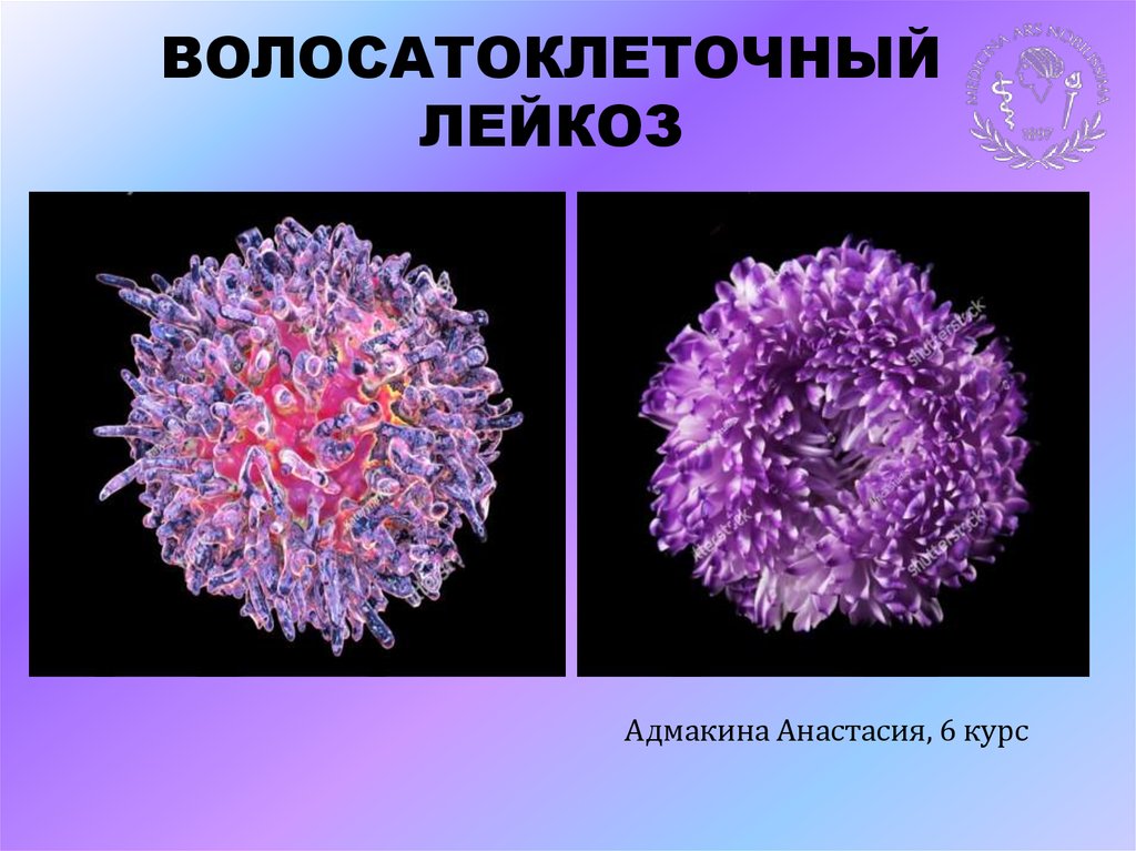 Волосатоклеточный лейкоз картина крови