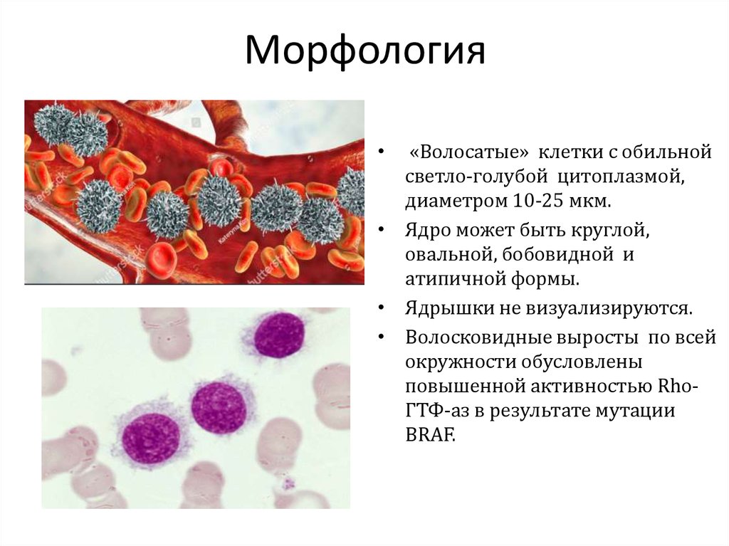 Волосатоклеточный лейкоз картина крови