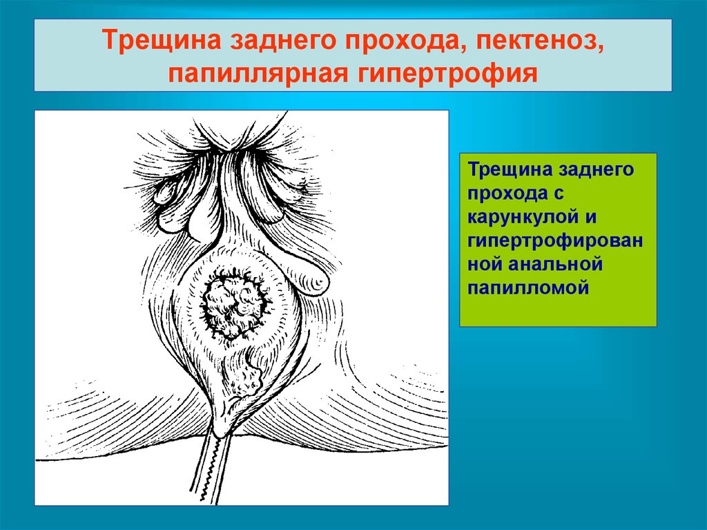 Трещины заднего прохода презентация