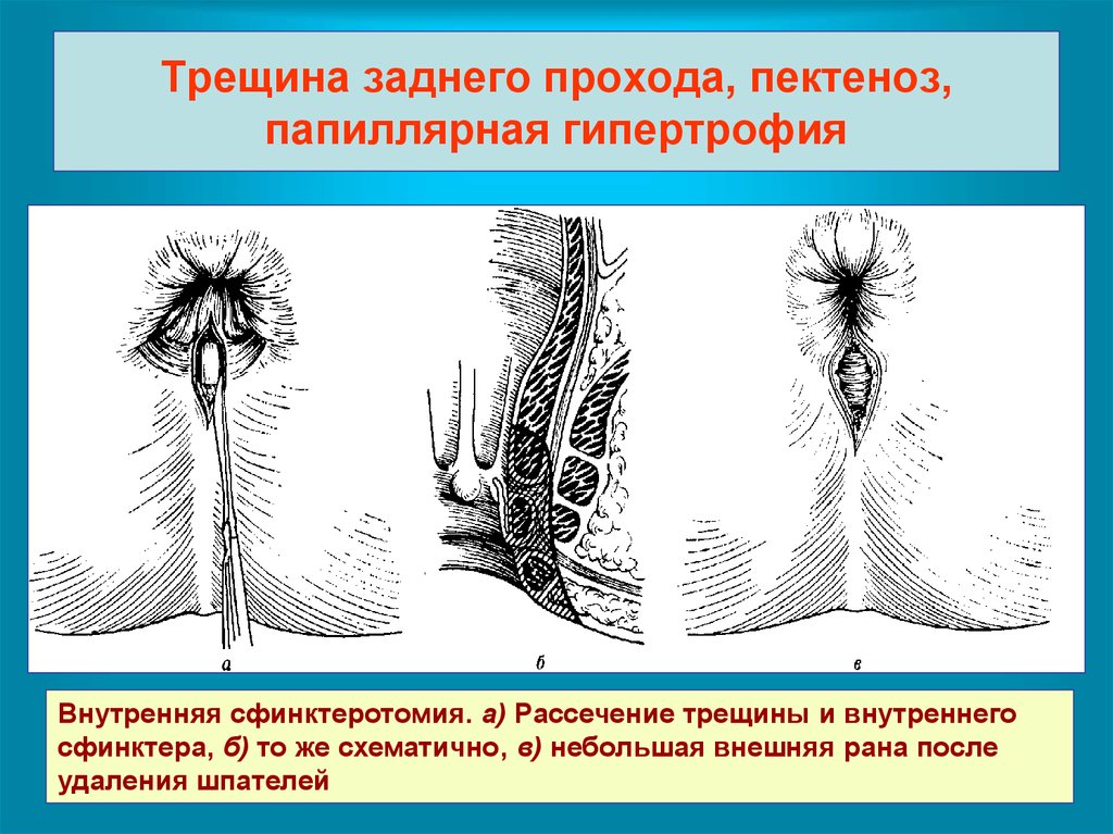 Трещины заднего прохода презентация