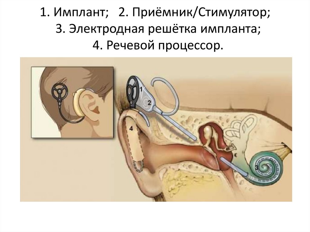 Схема работы кохлеарного импланта