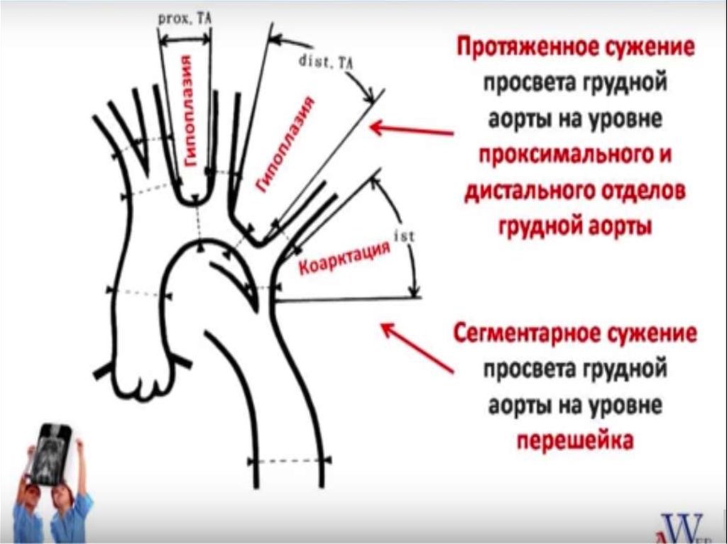 Коарктация аорты форум