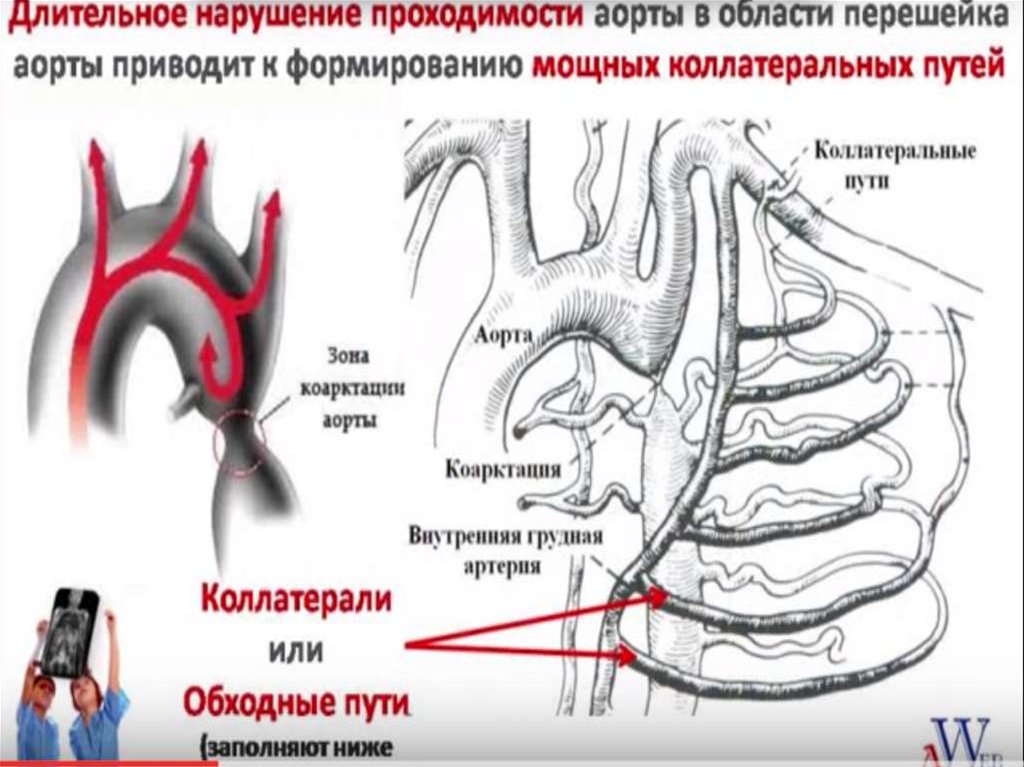 Коарктация аорты презентация