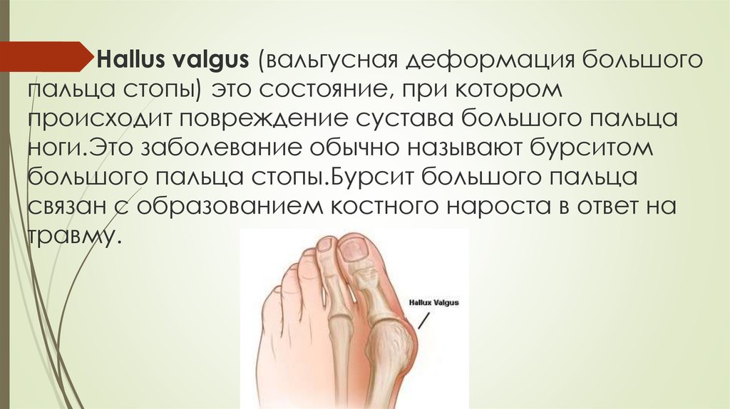 Деформация пальцев стопы мкб. Степени вальгусной деформации 1 пальца. Сустав большого пальца стопы деформация. Вальгусная деформация сустава большого пальца стопы. Деформация пальцев стопы.