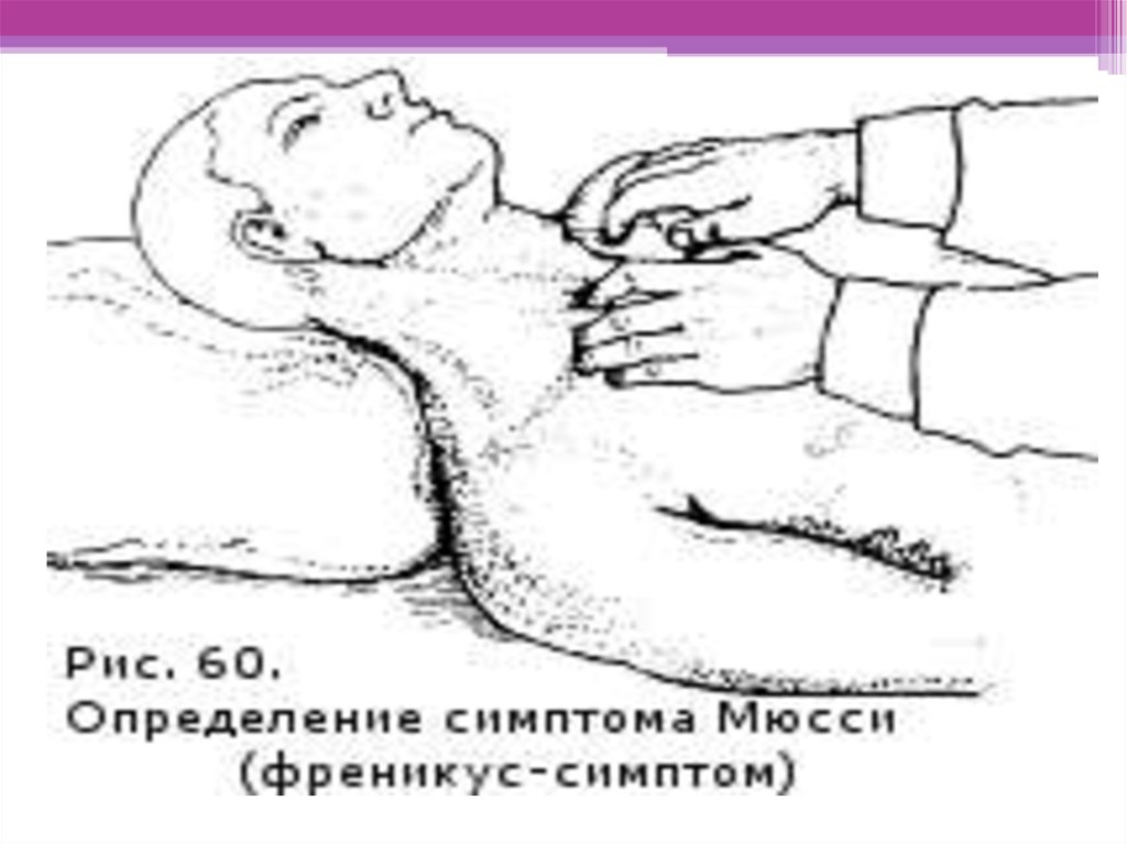 Симптом кера при холецистите. Григорьевского Мюсси симптом. Симптом Мюсси (френикус-симптом). Симптом Ортнера Кера Мюсси Мерфи. Симптомы Ортнера, Мерфи, Георгиевского—Мюсси.