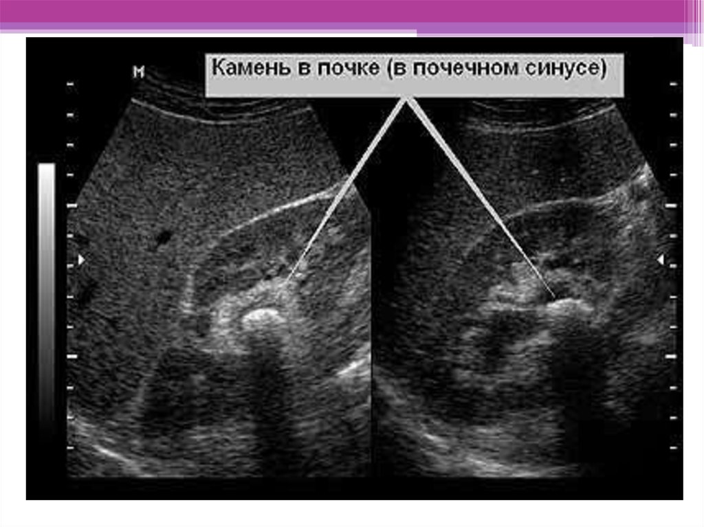 Уплотнение члс обеих почек