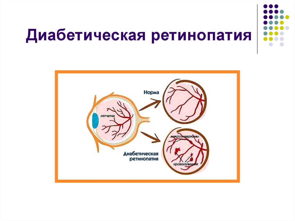 Диабетическая ретинопатия это. Диабетическая ретинопатия. Диабетическая ретинопатия презентация. Диабетическая ретинопатия схема. Диабетическая ретинопатия памятка.