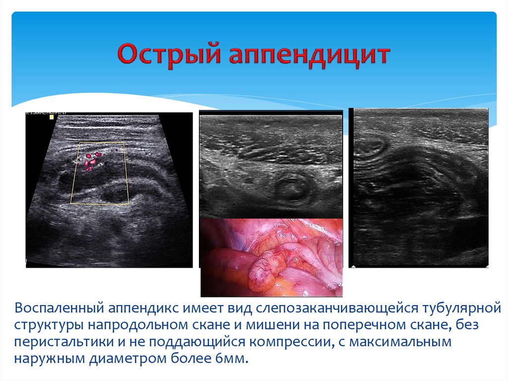 Острый аппендицит презентация