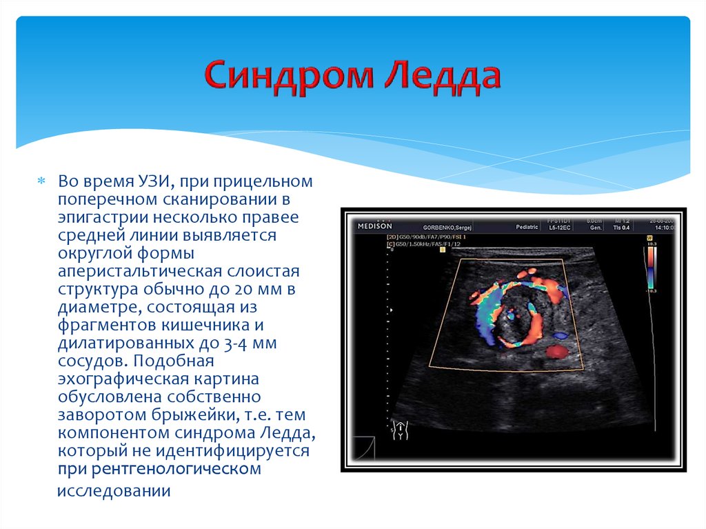 Синдромы узи. Мальротация синдром Ледда. Синдром Ледда ирригография.