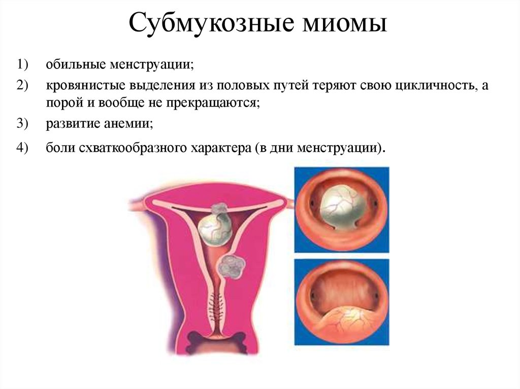 Месячные при миоме. Основная проблема больных при субмукозной миоме. Субмукозные миомы матки. Осложнения субмукозных миом матки.