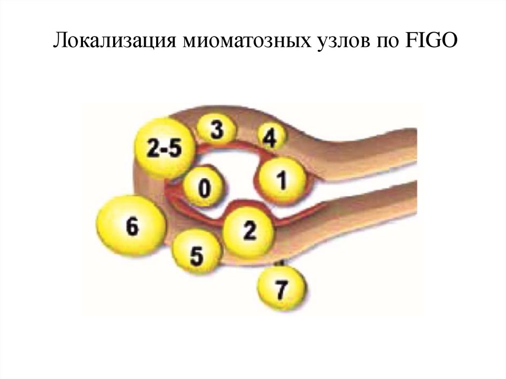 Типы миом. Миоматозные узлы по Figo. Классификация узлов миомы по Фиго.