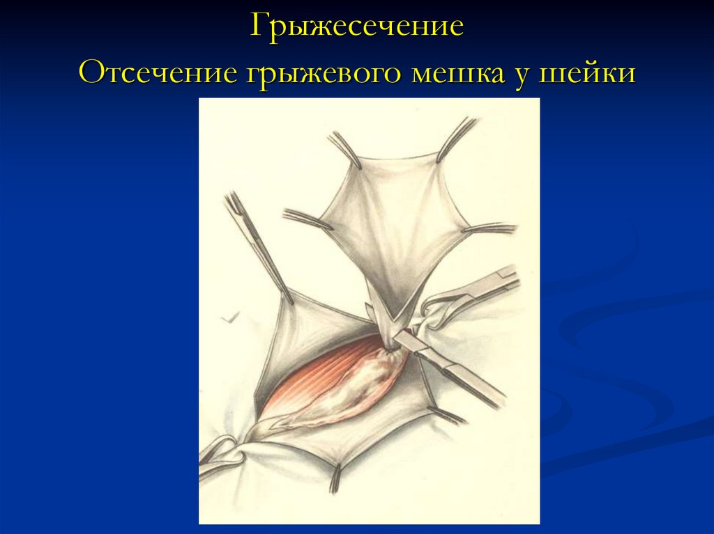 Пластика грыж. Краснобаеву грыжесечение. Аппендэктомия грыжесечение. Иссечение грыжевого мешка.