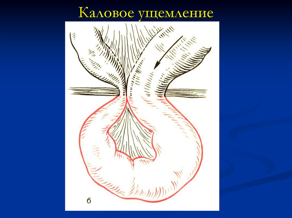 Ущемление пупочной грыжи. Ущемление в грыжевом мешке.