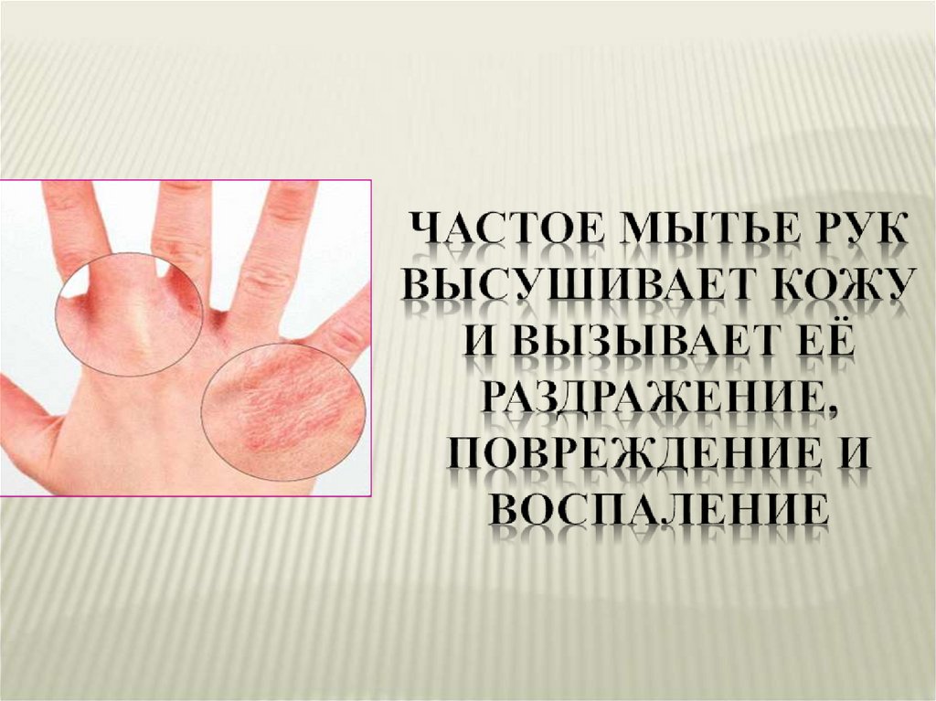 Частое мытье рук высушивает кожу и вызывает её раздражение, повреждение и воспаление