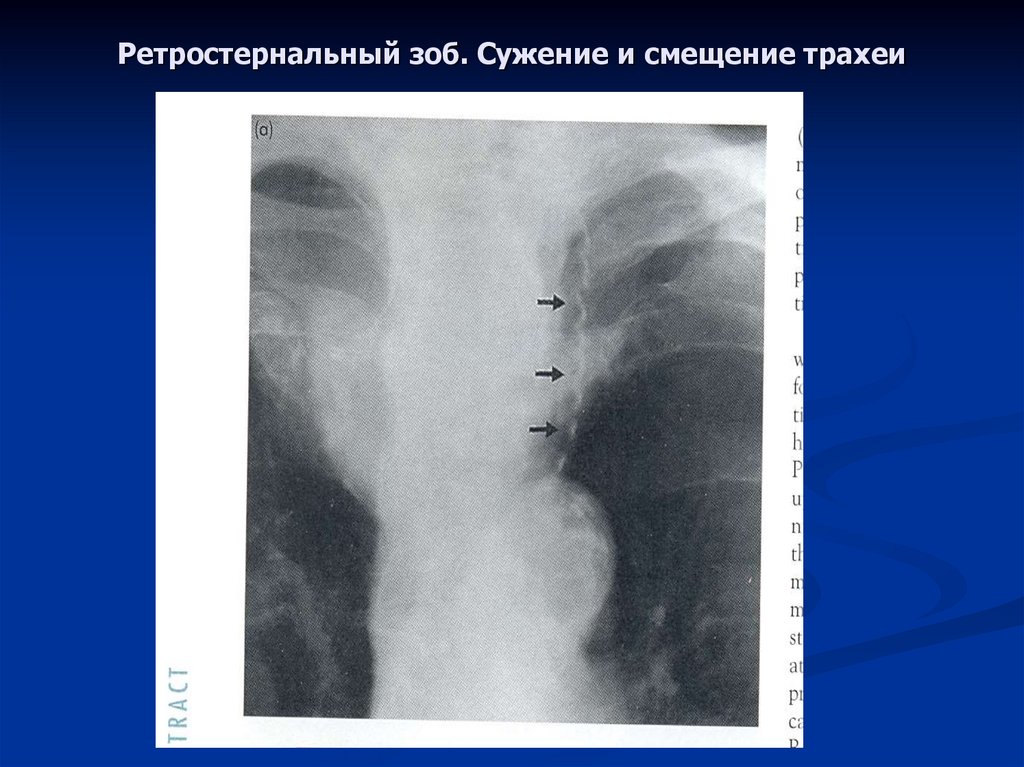 Пищевод зоб. Обызвествление щитовидной железы на рентгене. Смещение трахеи на рентгене. Зоб щитовидной железы рентген.