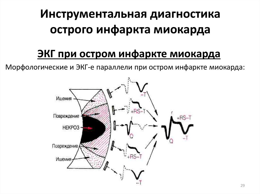 Диагностика инфаркта миокарда