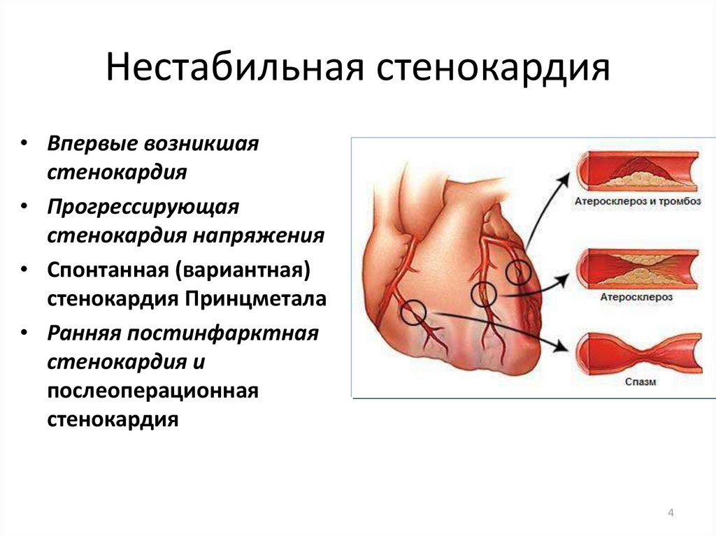 Нестабильная стенокардия презентация