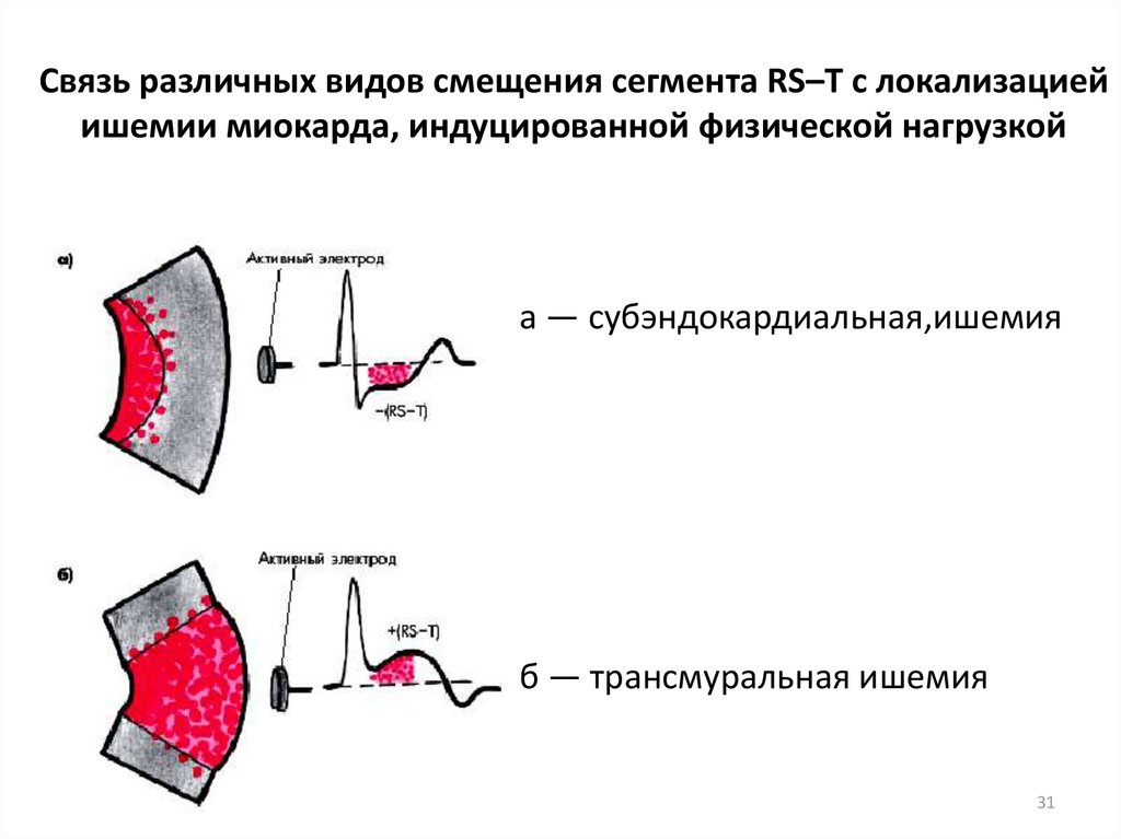 Локализация ишемии