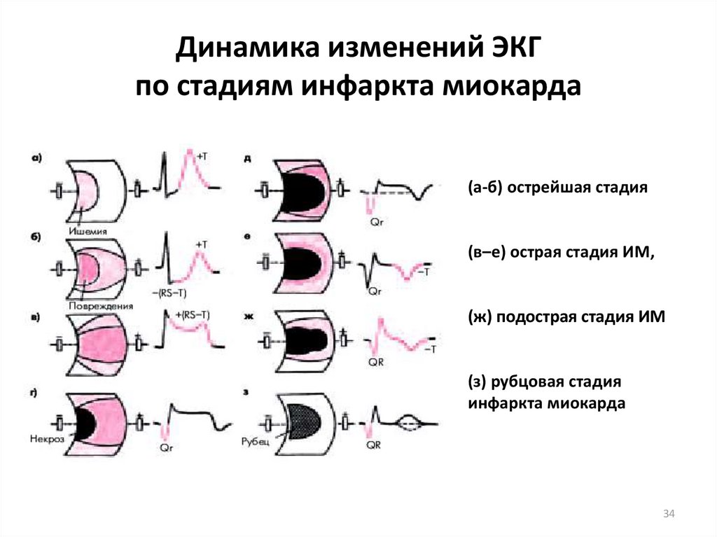 Стадии инфаркта миокарда