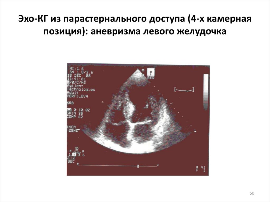 Картине истинной аневризмы в области верхушки миокарда левого желудочка соответствует