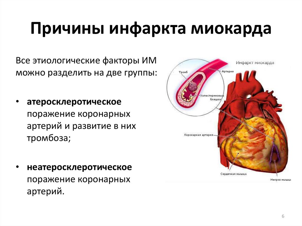Инфаркт миокарда при недостаточности фтора