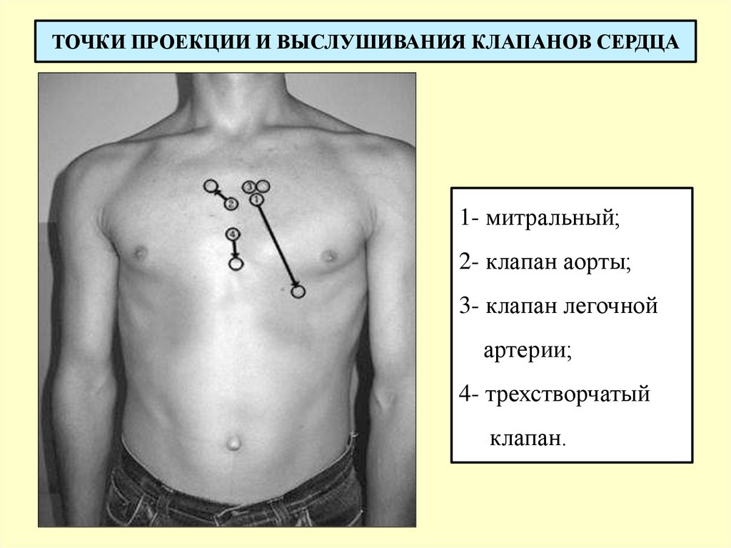 Пролабирование створок клапанов сердца