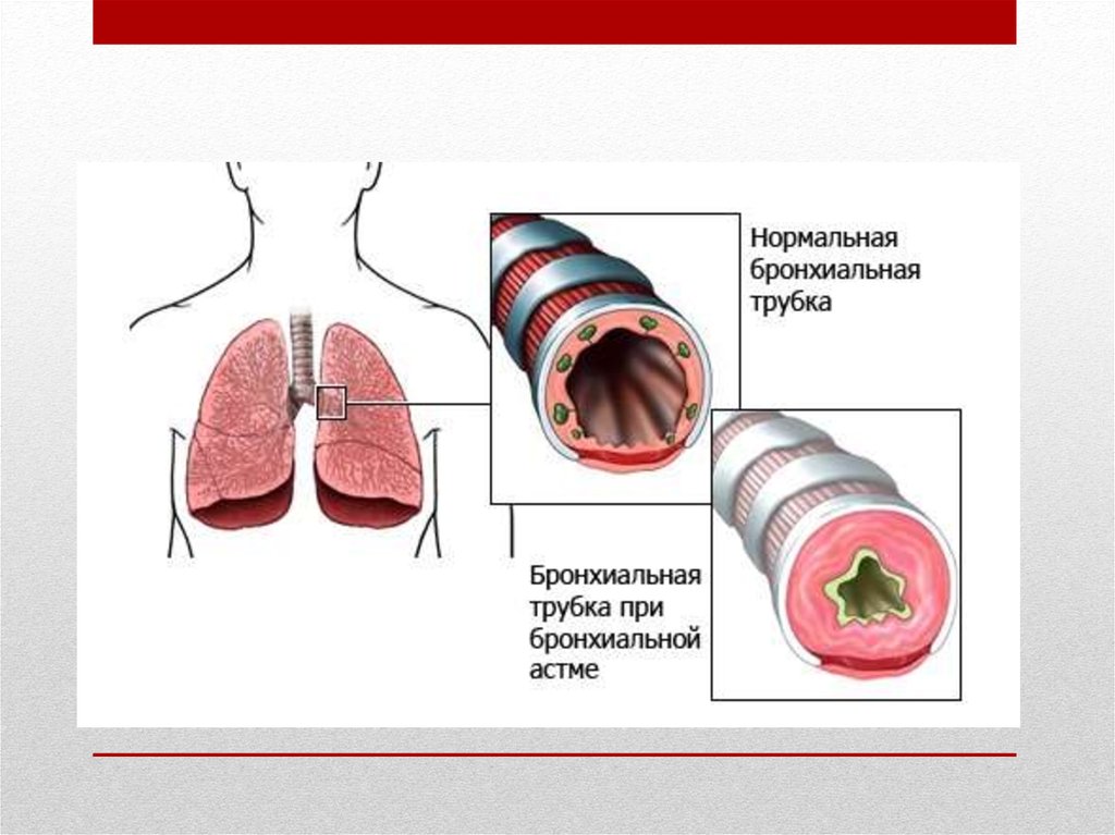 Бронхит презентация қазақша