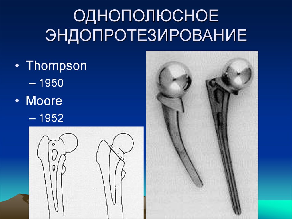 Эндопротезирование суставов презентация