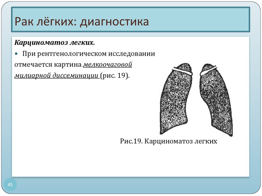 Карциноматоз легких рентгенологическая картина