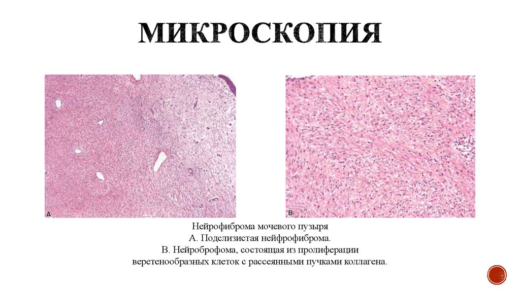 Мезенхимальные опухоли патанатомия презентация